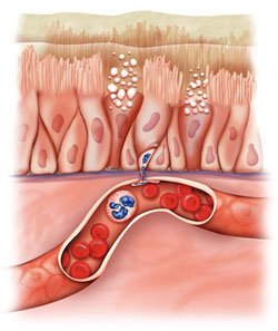 diagram of airway inflammation